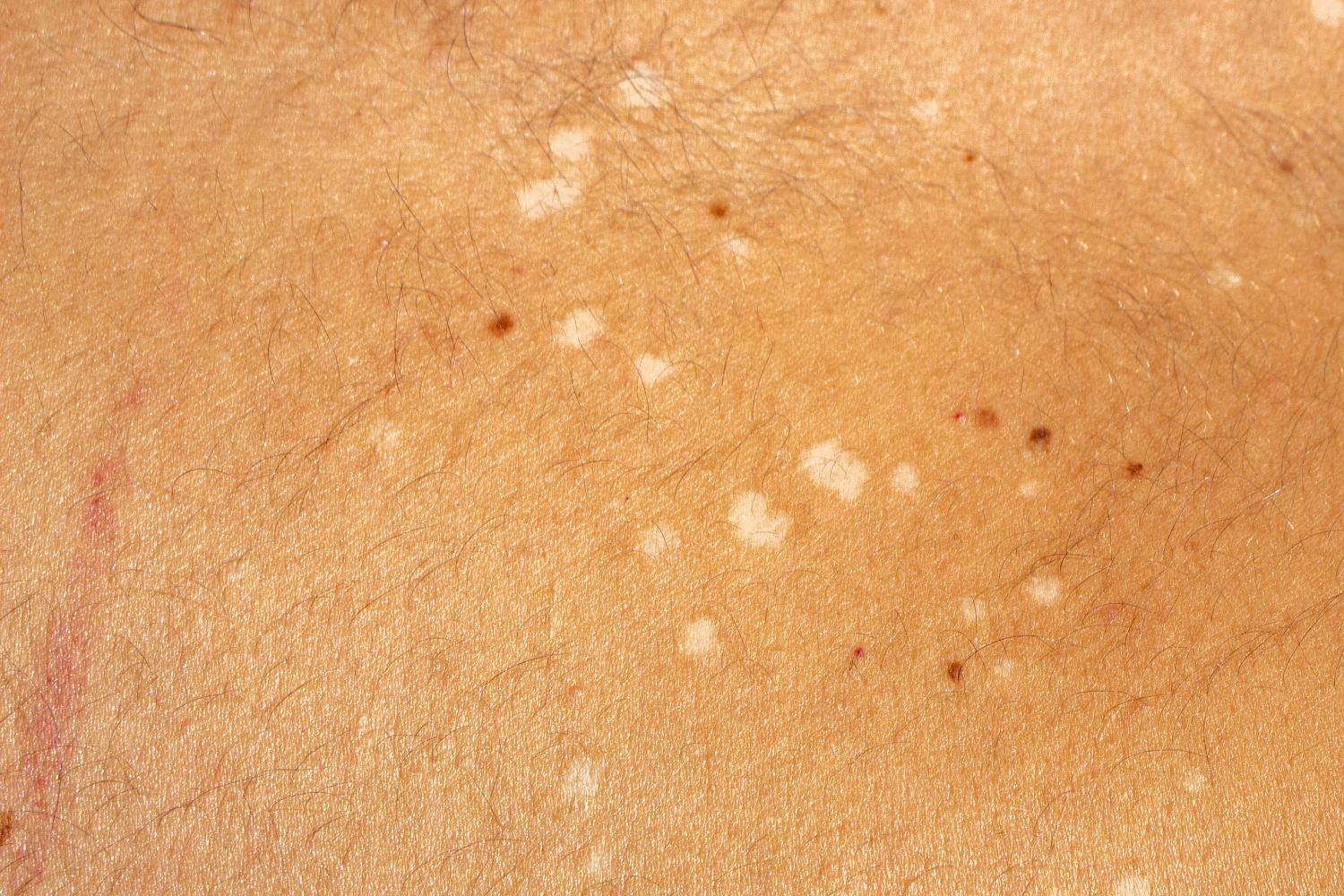 Skin Conditions SkinDC Skin Treatment Arlington