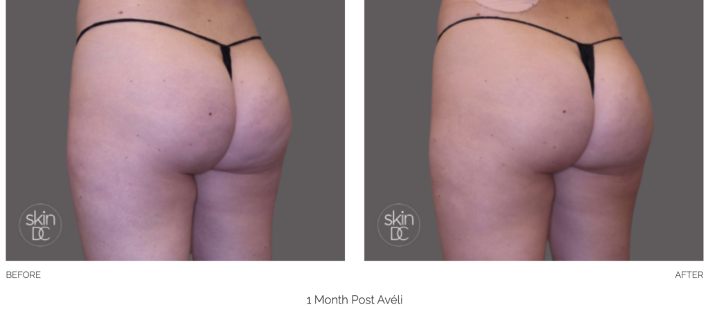 Avéli Gallery SkinDC Arlington VA Cellulite Treatment