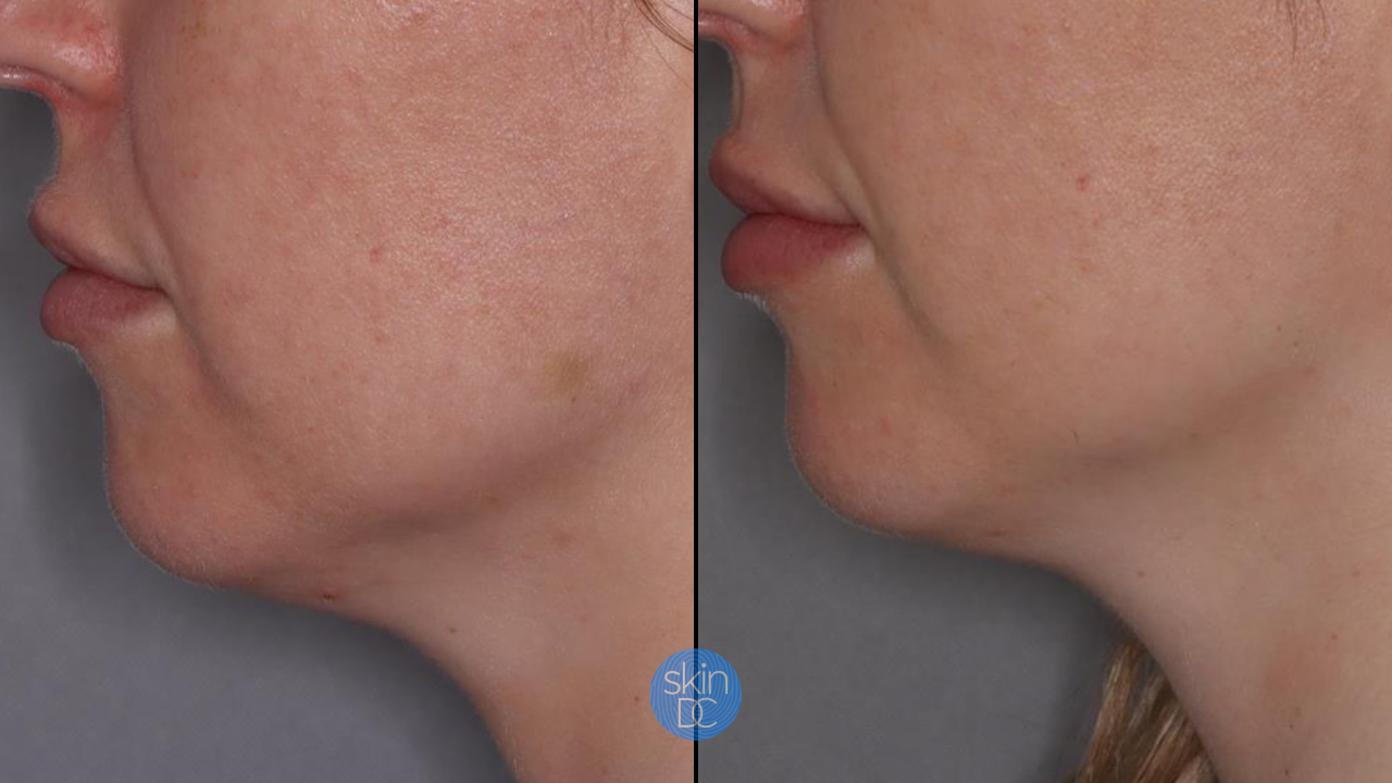 Lower Face